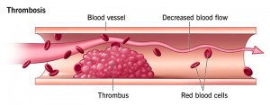 22242-thrombosis-illustration