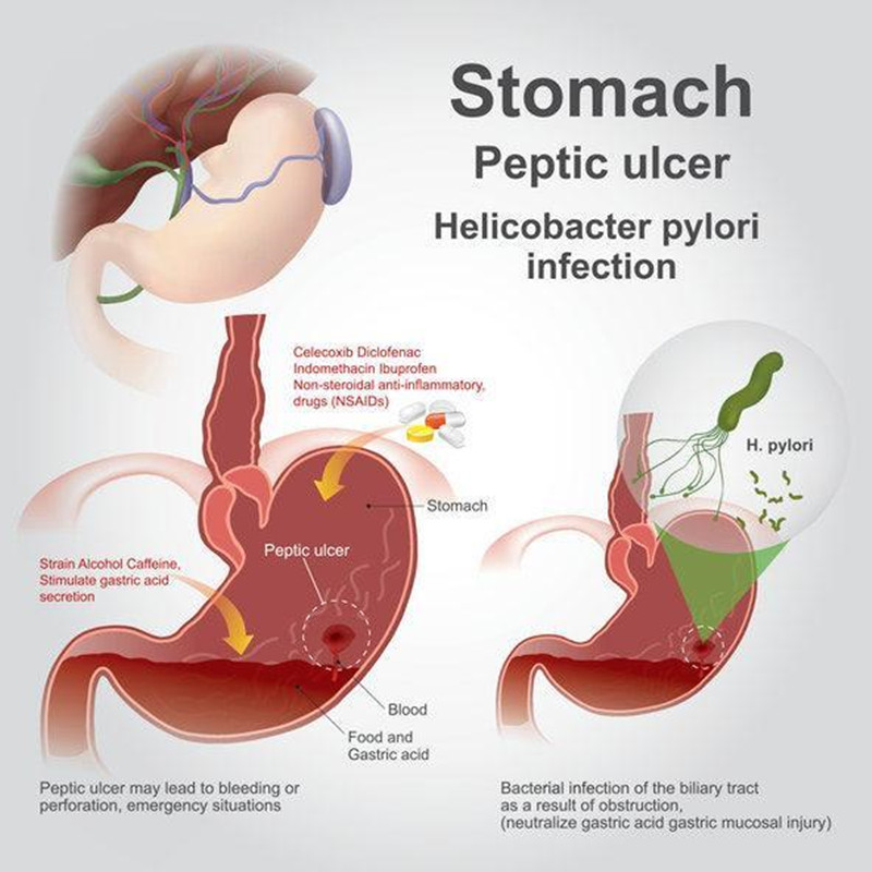 Is it Easy Infected by Eating with Someone Who Has Helicobacter Pylori?