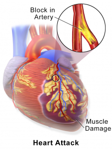 Blausen_0463_Heart Attack