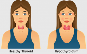 Thyroid 